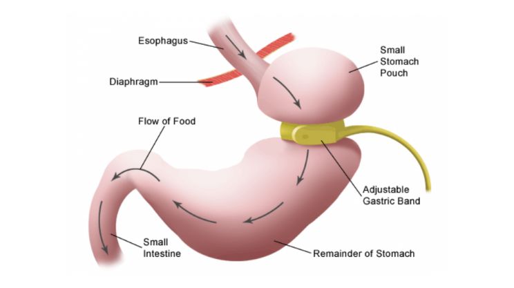 Adjustable Gastric Band