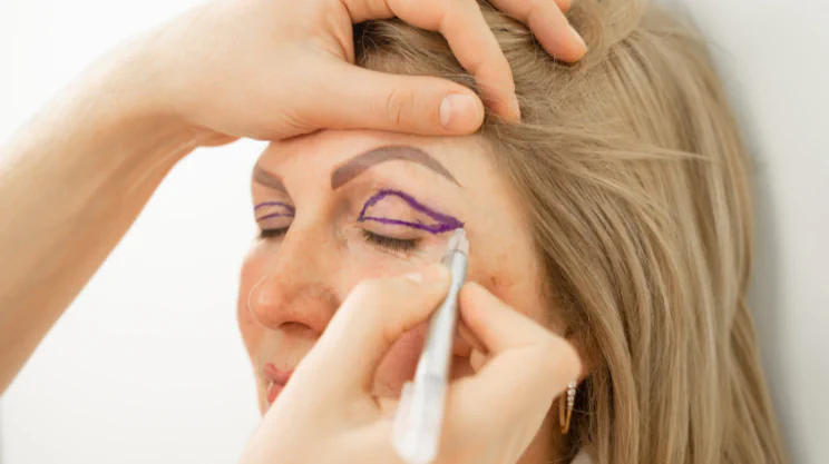Blepharoplasty, Eye lid surgery at FlytoDoc
