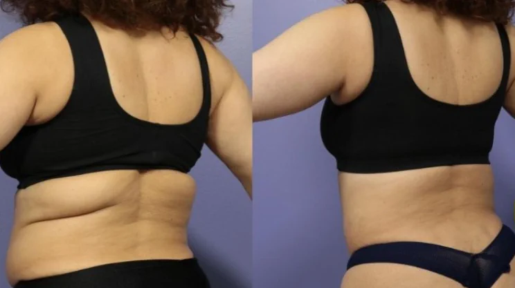Bra Line Lift, Upper Back Lift, Body Contouring
