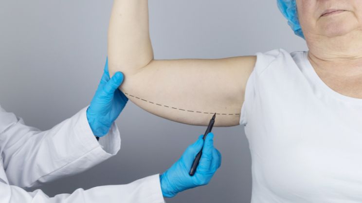 Brachioplasty, Arm_Lift