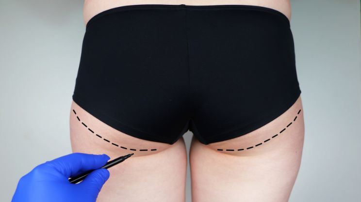 Buttock_Augmentation, Gluteoplasty