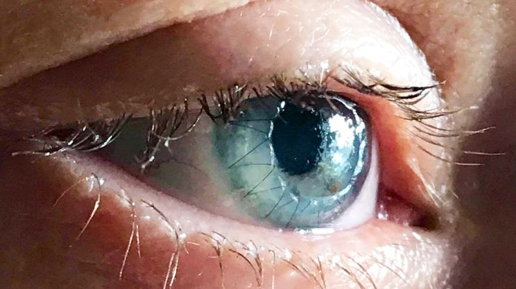 Corneal Transplant