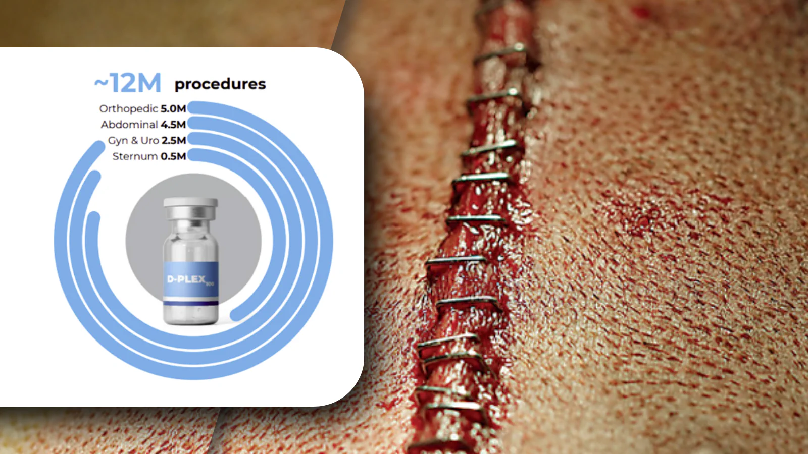 Revolutionary D‑PLEX₁₀₀ for Surgical Site Infection Prevention