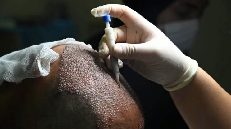 DHI Hair Transplant at FlytoDoc