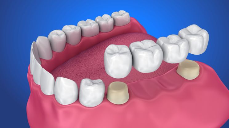 Dental Bridges