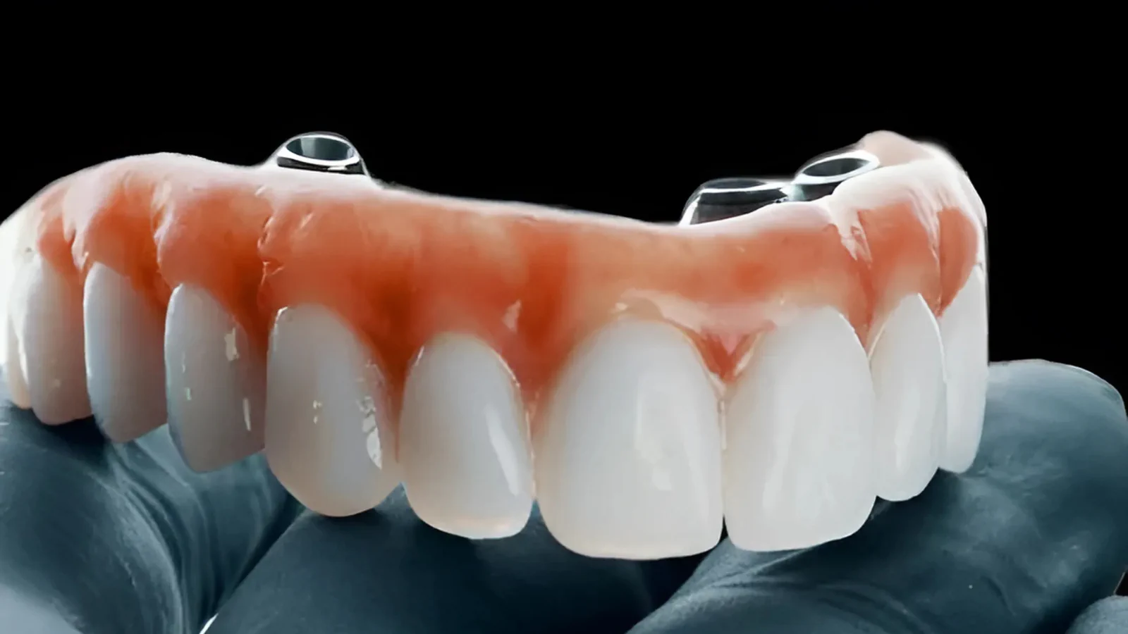 Dental-Implant-For-Dentures