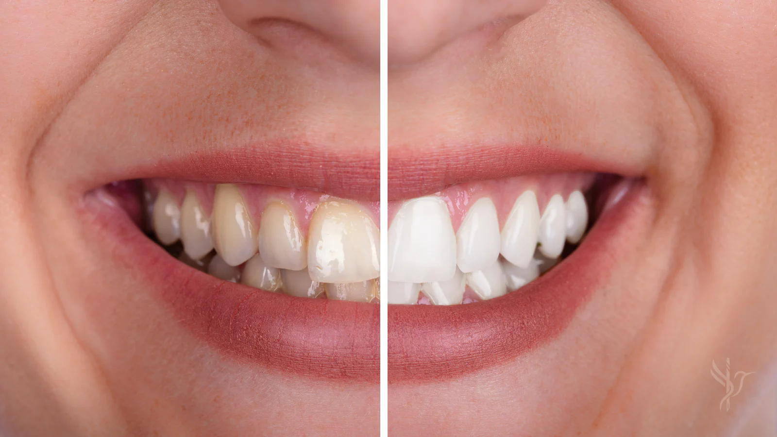 Nano Dental Whitening by FlytoDoc dentists