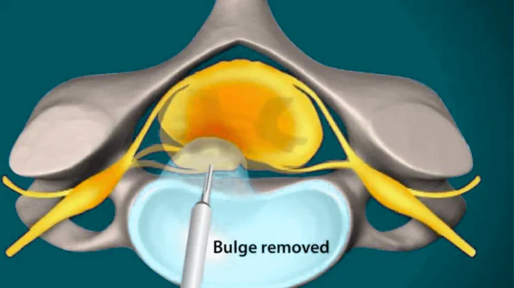 Discectomy