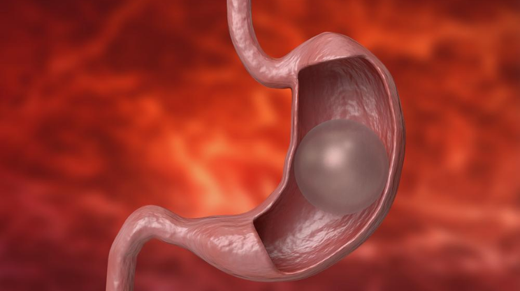 Gastric Baloon insertion