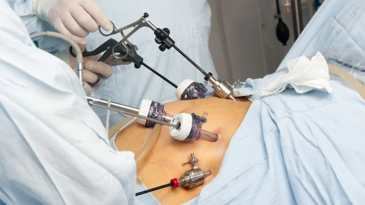 gastric bypass, gastric Sleeve