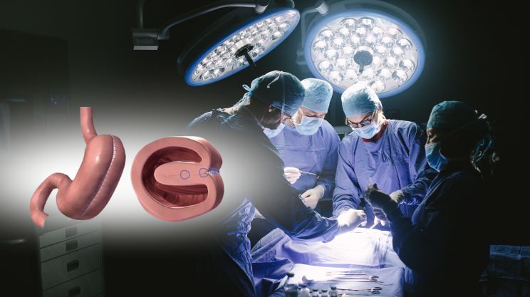 Laparoscopic Gastric Plication