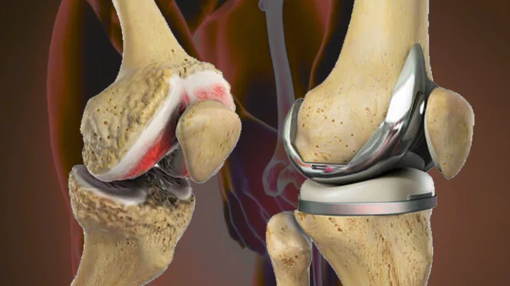 Total Knee Replacement