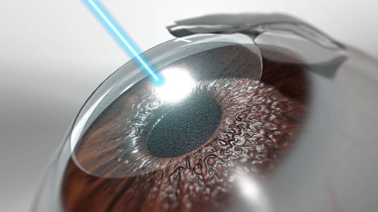 LASIK, Laser_Assisted_In_Situ_Keratomileusis