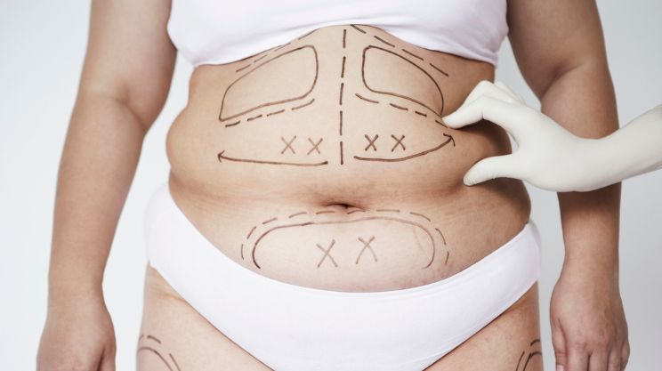 Lipoplasty, Liposuction