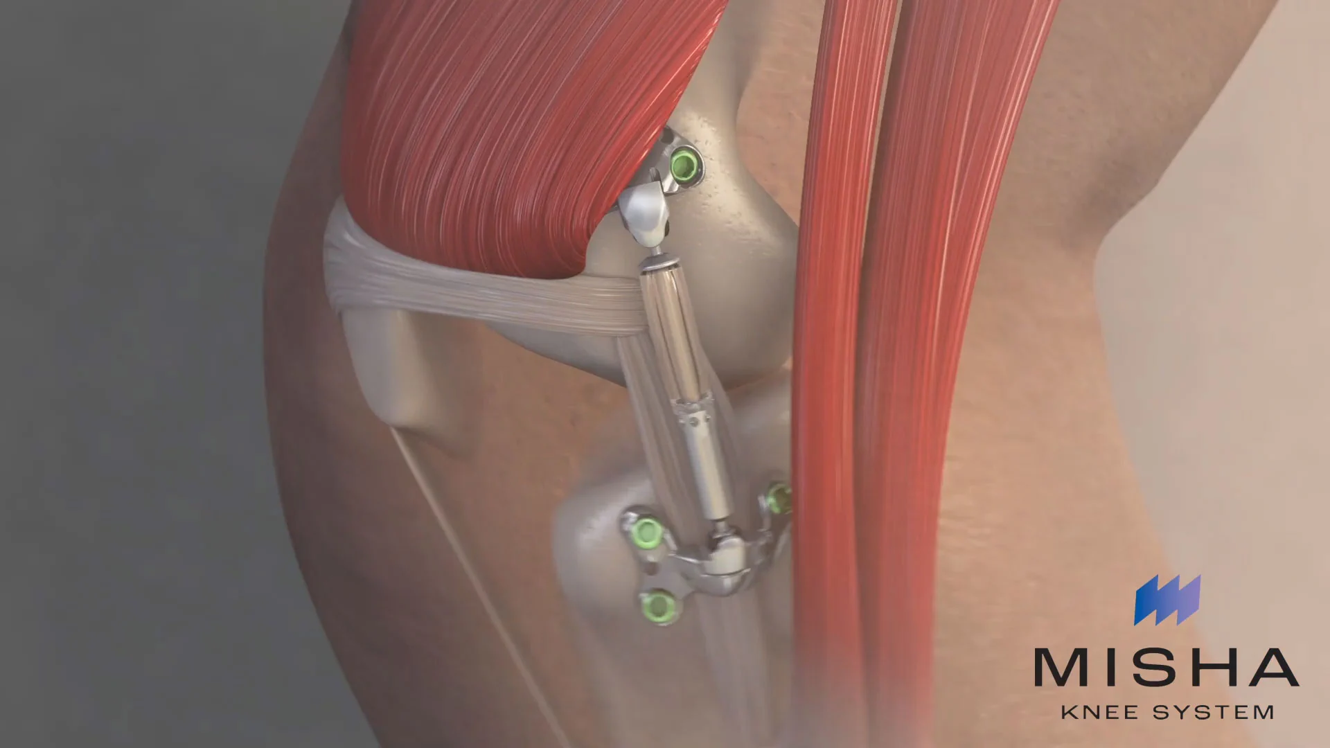 MISHA KNEE REPLACEMENT SYSTEM