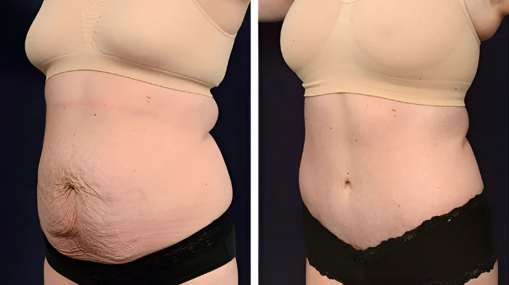 Mommy Makeover, Post-Pregnancy Body Restoration, Combined Cosmetic Surgery FlytoDoc