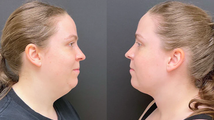 Neck Lift, Lower Rhytidectomy at FlytoDoc