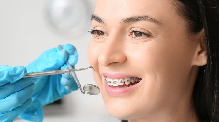 Orthodontic_Braces