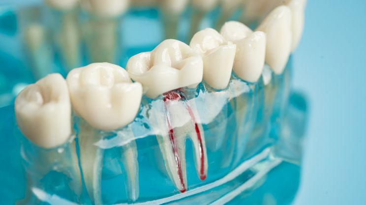 Endodontic_Treatment, Root_Canal_Therapy