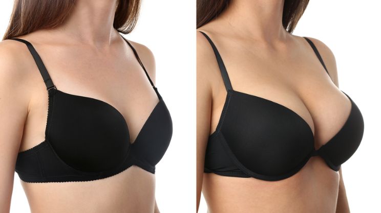 breast augmentation Mammoplasty