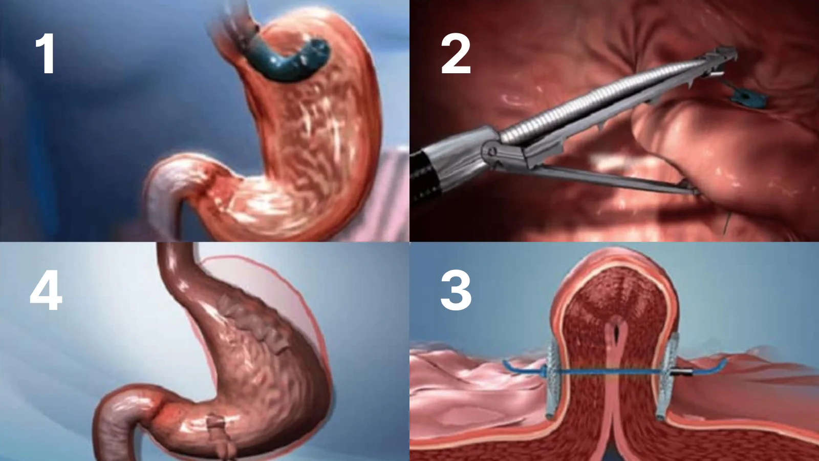 endoscopic-sleeve-gastroplasty